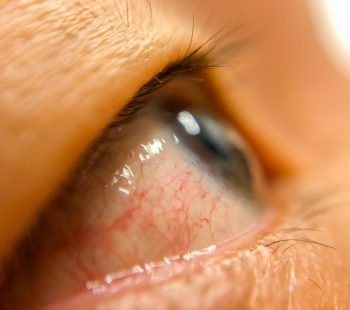 What Causes Red Eyes After Weed Use and How to Avoid it