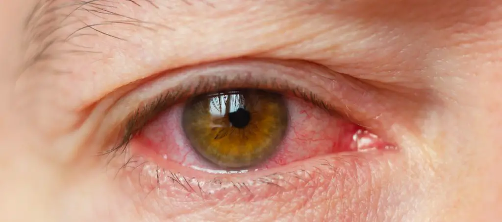 Red eyes