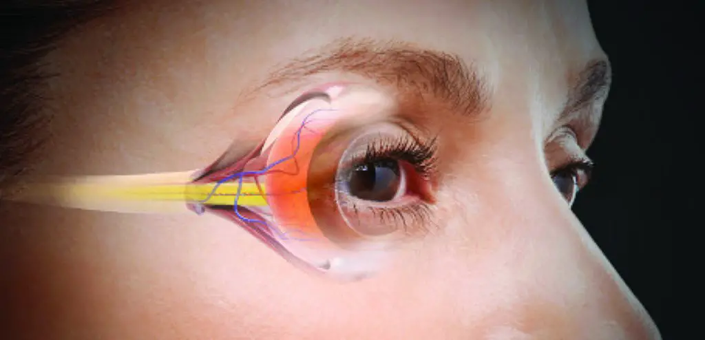 Marijuana and Glaucoma