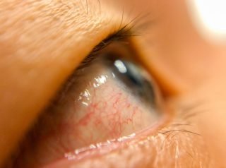 What Causes Red Eyes After Weed Use and How to Avoid it